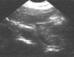 tale of pancreas atrophy - Ultrasound