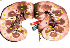 right kidney stone - Sensitiv diagnostics