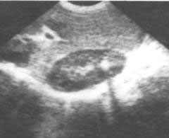 right kidney stone - Ultrasound