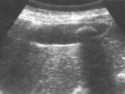large concretion in gall bladder - Ultrasound
