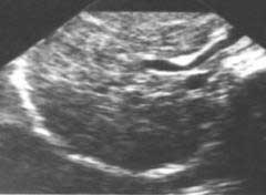 macronodular cirrhosis - Ultrasound